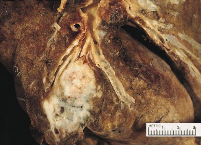 tumore ai polmoni