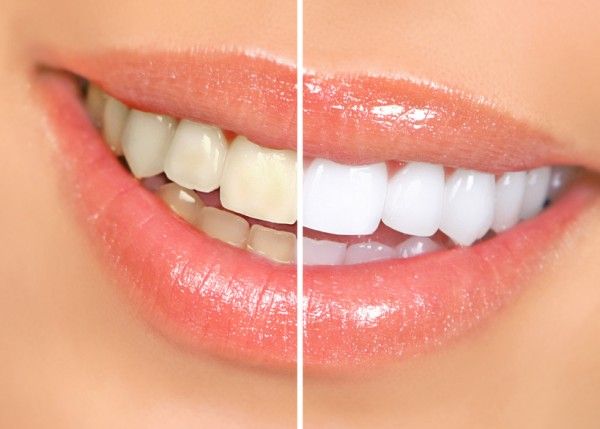 Denti bianchi: come sbiancarli