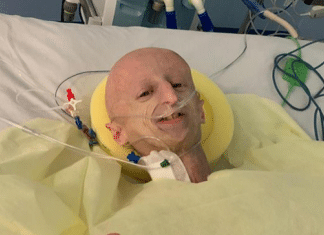 Sammy Basso affetto da progeria operato al cuore